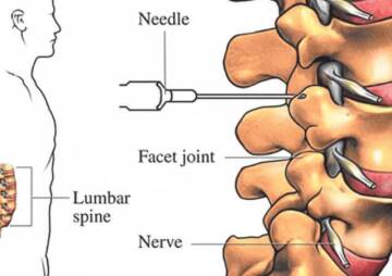 What are Spinal Injections’ Side Effects?