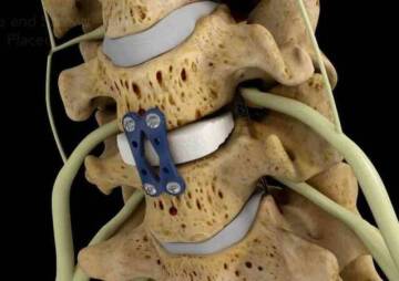 Types of spinal fusion surgeries