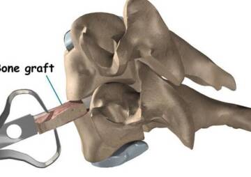Spinal bone graft
