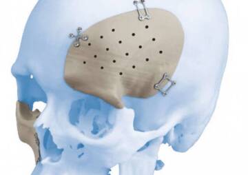 PEEK Implant Skull Which Saves Lives
