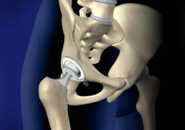 How Long Does Hip Replacement Last?