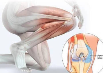 Plica Syndrome Is One of The Main Causes Of Knee Pain