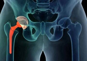 Find Out More About The Various Types Of Hip Replacement