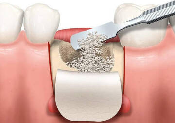 تمام آنچه که باید در مورد پیوند استخوان دندانی بدانید