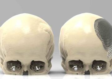 Cranioplasty and its meaning