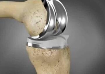 How long do metal implants last in the body? The question you should ask before implant placement