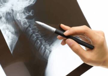 Cervical Spine Surgery Complications You Should Know About Them