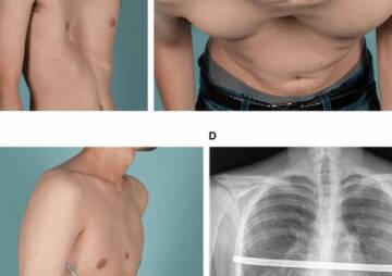 Are you worried about pectus excavatum pain and surgery?