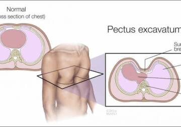 When does pectus excavatum require surgery?