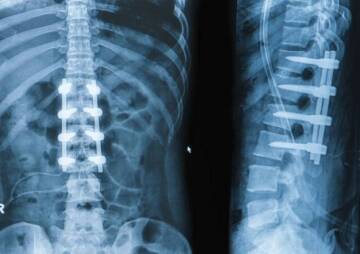 Spinal Fusion Surgery Success Rate