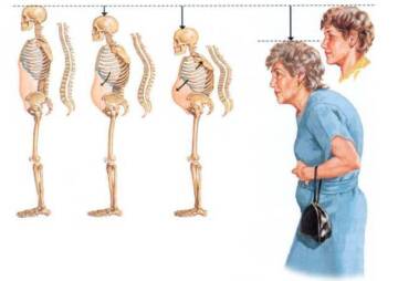 Osteoporosis and fractures of the spine, a silent but dangerous disease