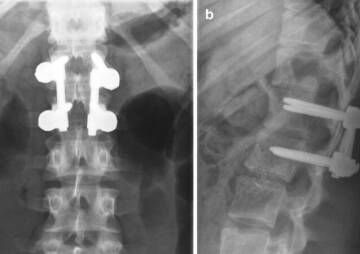 Titanium rods in back surgery