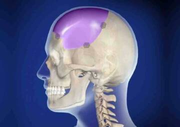 when cranioplasty is necessary?