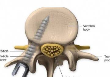 How orthopedic pedicle screws use in spine surgery